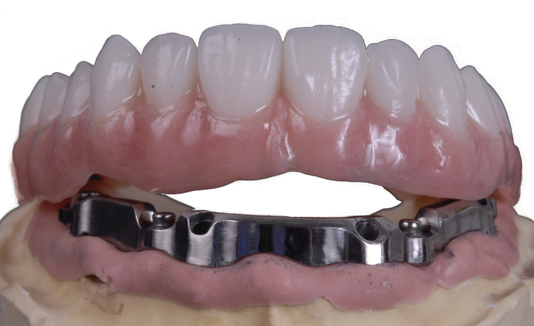 Implant Bars - Evolution Dental Lab